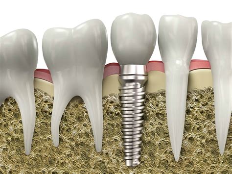 Dental Implant Images