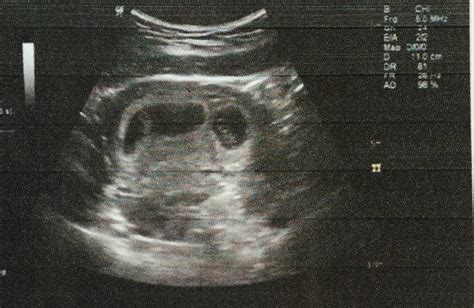 怀孕30周了，双胎，其中一胎儿右肾有问题，下面上传B超单子，有懂的帮忙看看，现在心里没底啊！ - 百度宝宝知道