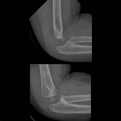 olecranon fracture | pacs