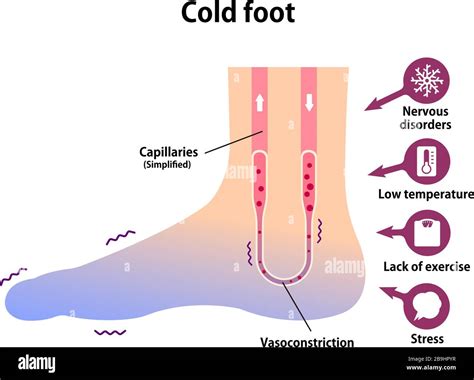 Poor Circulation High Resolution Stock Photography and Images - Alamy