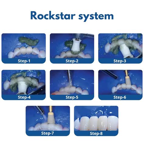 Buy Bioclear Rockstar Polisher Kit – Oralkart