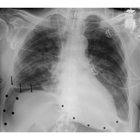American Thoracic Society on LinkedIn: Chest X-ray with suspected deep sulcus sign (with black ...