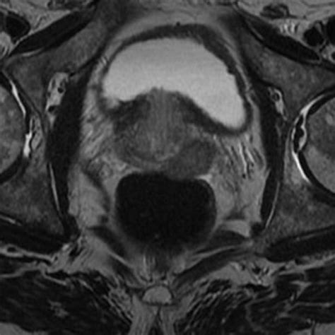 Prostate Cancer MRI | Kaggle