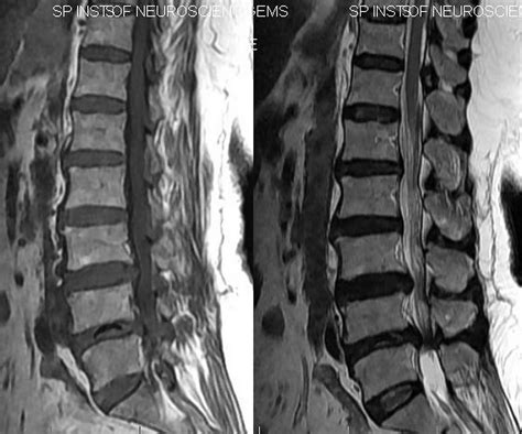 Vacuum Disc Phenomenon Radiology at Benjamin Range blog