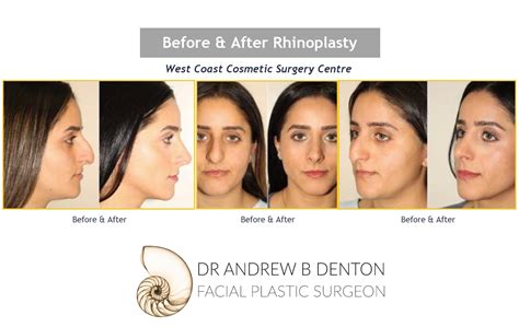 Rhinoplasty Recovery Tape at Patrick Drago blog