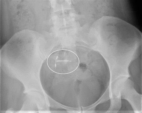 Phleboliths mistaken for intraperitoneal copper-containing intrauterine ...