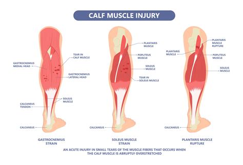 Achilles Tendonitis vs. Calf Strain - Run Pain-Free Again