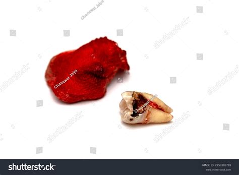 One Molar Tooth Decay Extracted Placed Stock Photo 2253305769 | Shutterstock