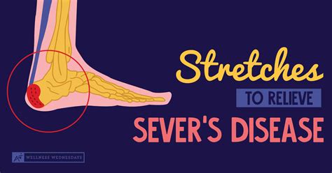 Sever's Disease Stretches - Stretches to Help Relieve Sever's Disease ...