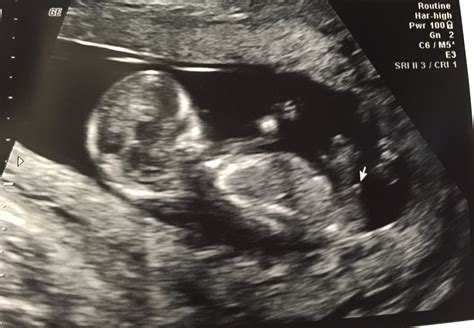 14 Week Ultrasound Male
