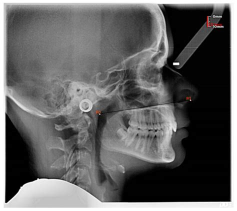 Cross-Sectional Study on Lateral Skull Radiographs to Design a New ...