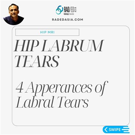 HIP LABRUM LABRAL TEAR MRI RADIOLOGY - Radiology Education Asia