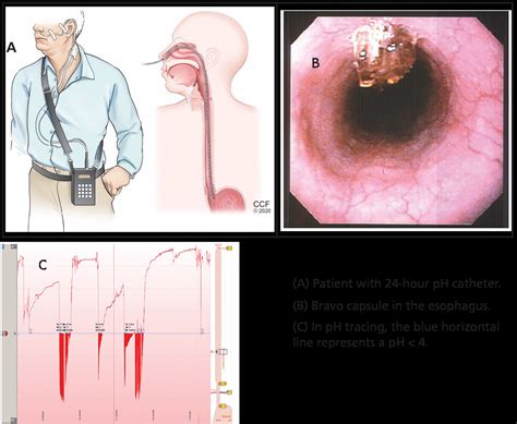 GERD: A practical approach | Cleveland Clinic Journal of Medicine