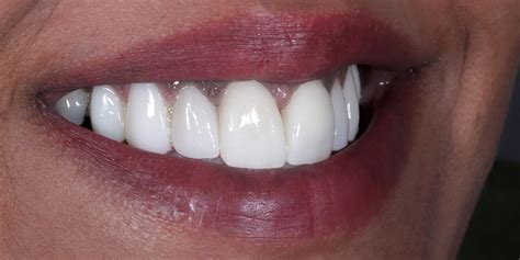Veneers - West Road Dental Practice