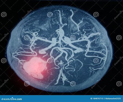 MRA Brain Or Magnetic Resonance Angiography Image MRA Of Cerebral ...