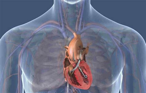 Novel post-closure technique reduces vascular complications related to ...