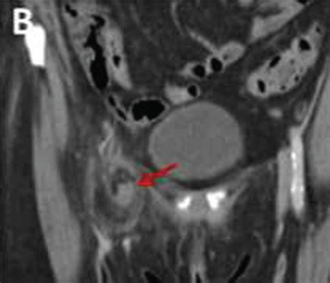 Image result for Normal Appendix Coronal