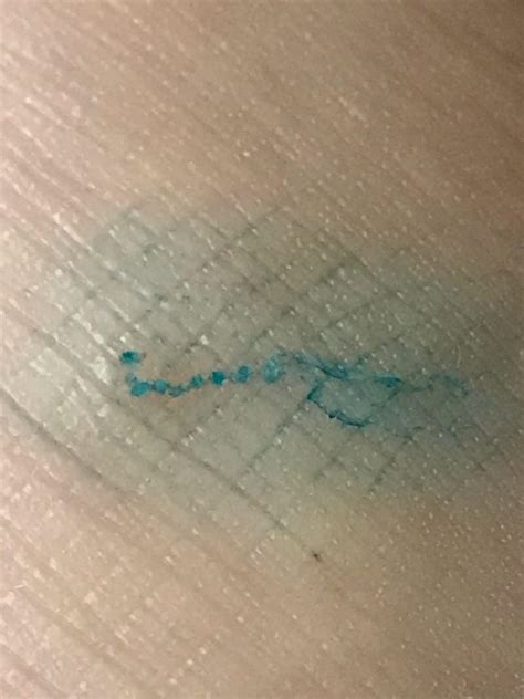 Scabies Burrow Ink Test