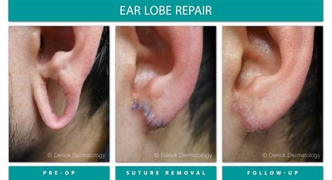 Earlobe Repair Surgery
