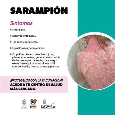 Identifica los síntomas del sarampión y protege tu salud: SSM – El Clarín