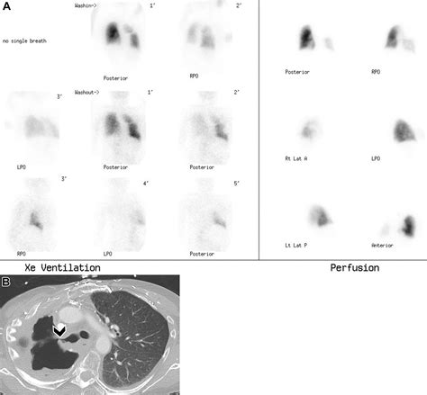 Ventilation-Perfusion Scan: A Primer for Practicing RadiologistsRadioGraphics