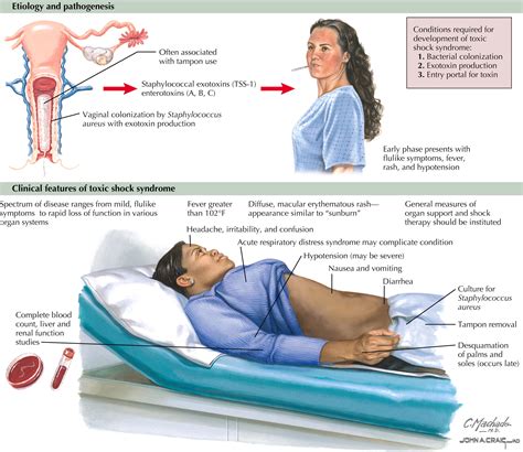 Toxic Shock Syndrome - Clinical Tree