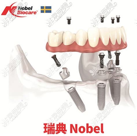 瑞典诺贝尔种植体几种型号价格表,PMC/PCC/active一颗多少钱 - 口腔资讯 - 牙齿矫正网