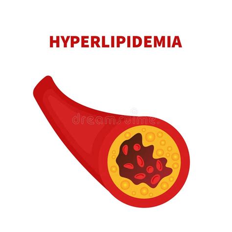 Hyperlipidemia Stock Illustrations - 405 Hyperlipidemia Stock ...