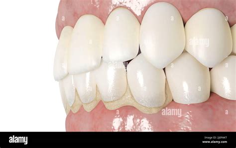 Image result for Tooth Calculus