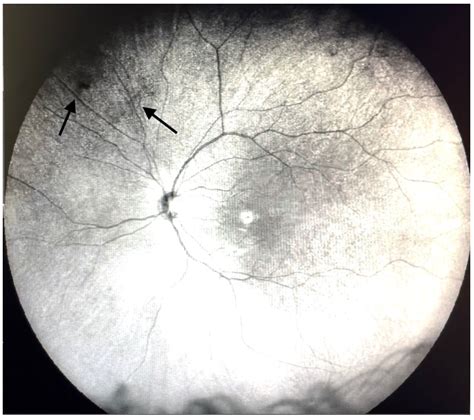 Visualization and Grading of Vitreous Floaters Using Dynamic Ultra-Widefield Infrared Confocal ...