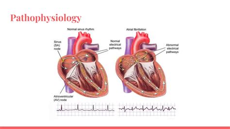 Atrial Fibrillation 的图像结果