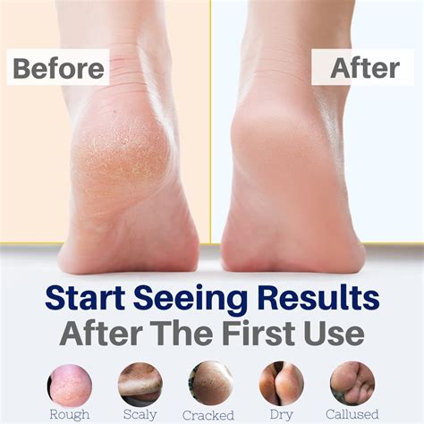 Crema antihongos para los pies totalmente natural Hidratante alivio orgánico para talones ...