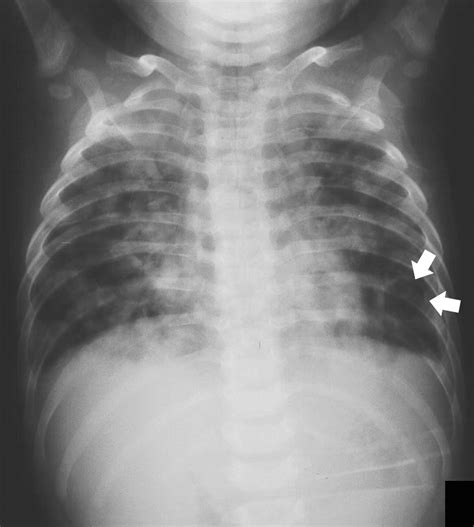 Xray Of The Thorax In Tuberculosis Radlinesorg