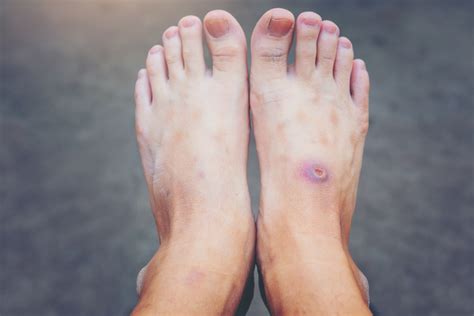 Diabetic Foot Ulcers: Understanding Stages and Essential Intervention ...