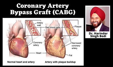 TCT 2021: CABG "remains the treatment of choice" for three-vessel ...