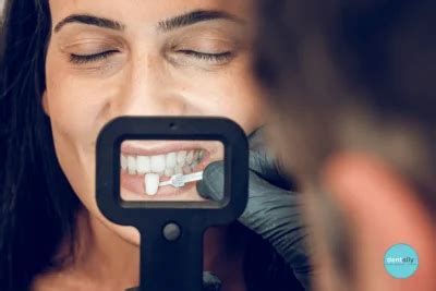 What is the Cost of Veneers for Two Front Teeth in India?