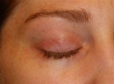 Rash on Eyelid - Pictures, Causes and Treatment