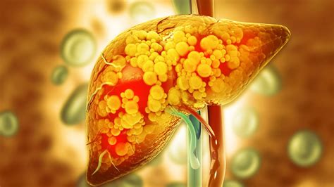 Unlocking the Hidden Mechanism: How Alcohol Leads to Fatty Liver Disease – Archyde