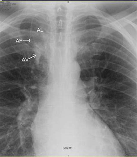 The azygos lobe and vein: interesting and typical clinical image | BMJ Case Reports
