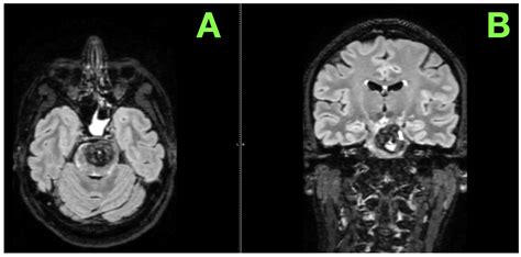 Large Pontine Cavernoma with Hemorrhage: Case Report on Surgical Approach and Recovery - hemorrhage in pons