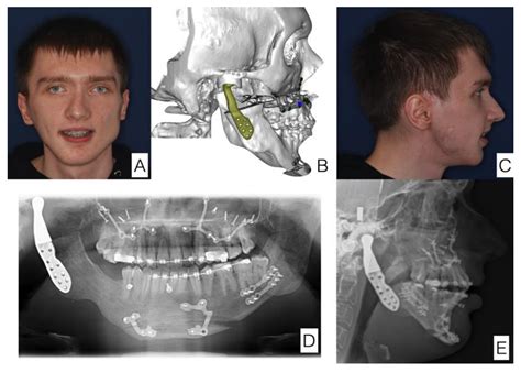 Protocol for Multi-Stage Treatment of Temporomandibular Joint Ankylosis ...