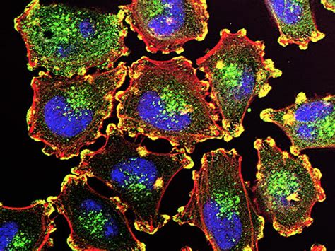 In Melanoma, Personalized Treatment Vaccines Show Promise - NCI