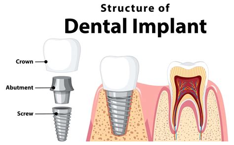 Image result for Different Types of Teeth Implants