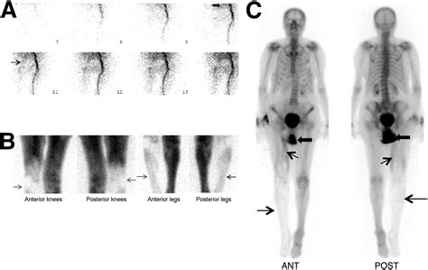 What Is A 3 Phase Bone Scan Radiology at Bernice Navarro blog