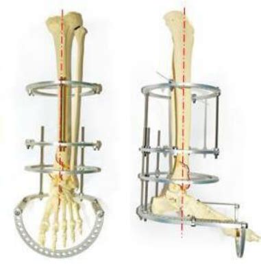 Image result for Normal Leg Alignment