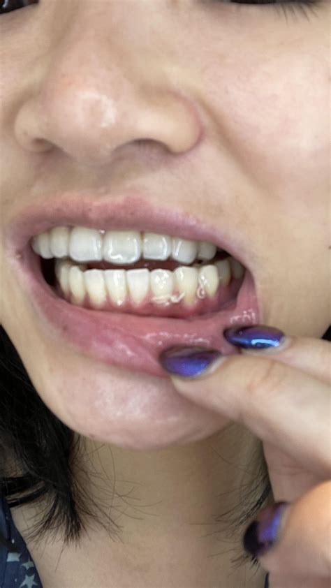 Mandibular tori removal and stitches post-Invisalign : r/Invisalign