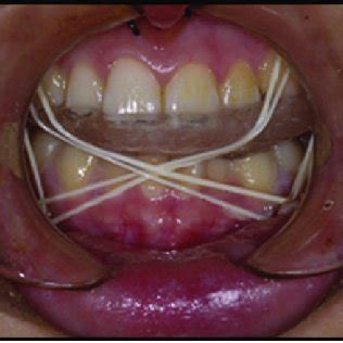 Intermaxillary fixation using fixation screw placed in the alveolar... | Download Scientific Diagram