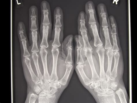 Rheumatologe: Rheumatoid Arthritis - Radiographic Progression
