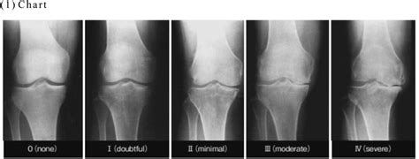 The Effectiveness of Endovenous Thermal Ablation for the Knee Symptoms of the Osteoarthritis ...