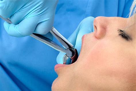 Difficult Tooth Root Extraction 的图像结果